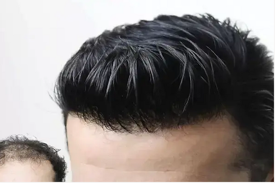 Elazığ Protez Saç